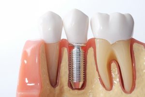 dental implant tooth replacement