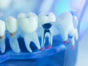 Root Canal Treatment Watford
