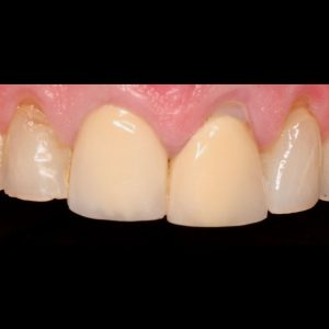 Discoloured crowns