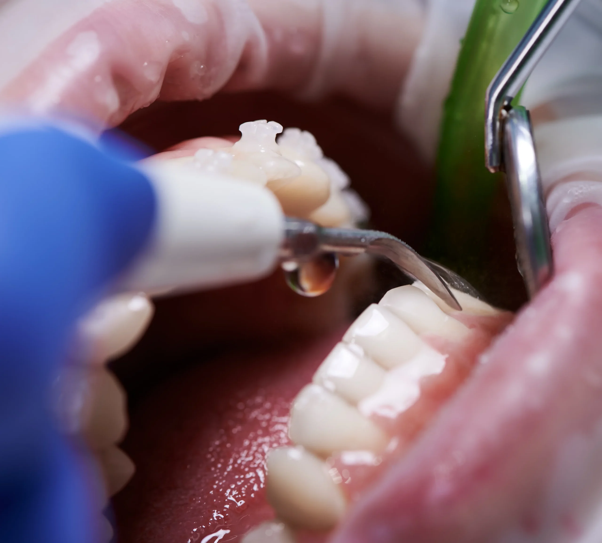 dentist in watford doing cleaning teeth
