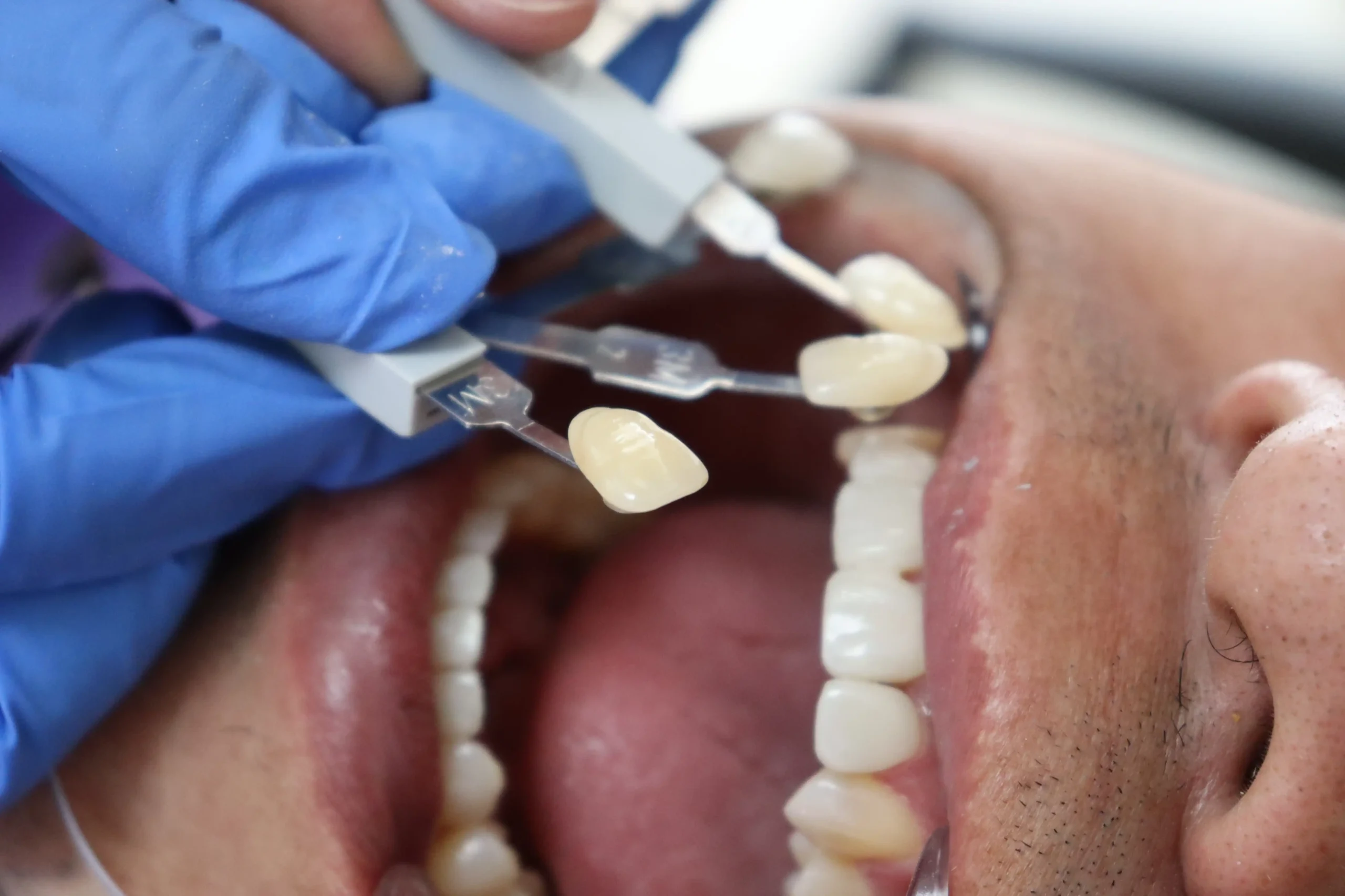 dentist checking shade colour for composite bonding in better care clinic